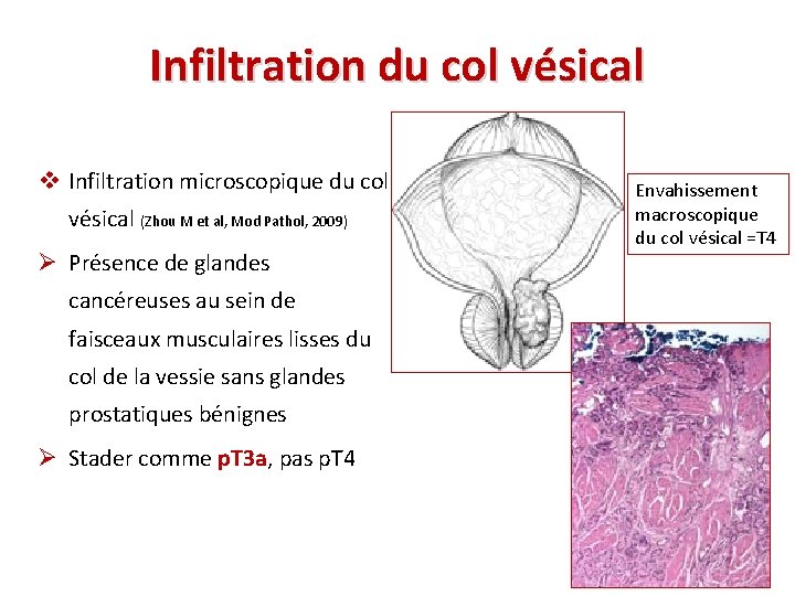 Infiltration du col vésical v Infiltration microscopique du col vésical (Zhou M et al,