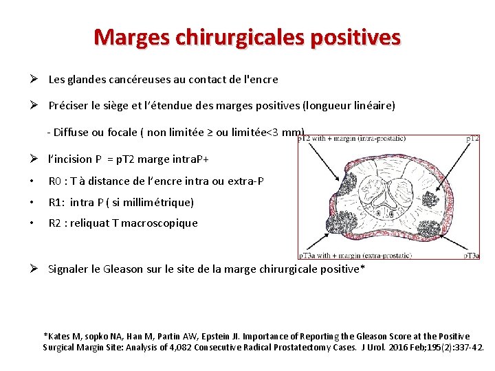 Marges chirurgicales positives Ø Les glandes cancéreuses au contact de l'encre Ø Préciser le
