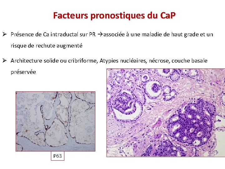 Facteurs pronostiques du Ca. P Ø Présence de Ca intraductal sur PR associée à