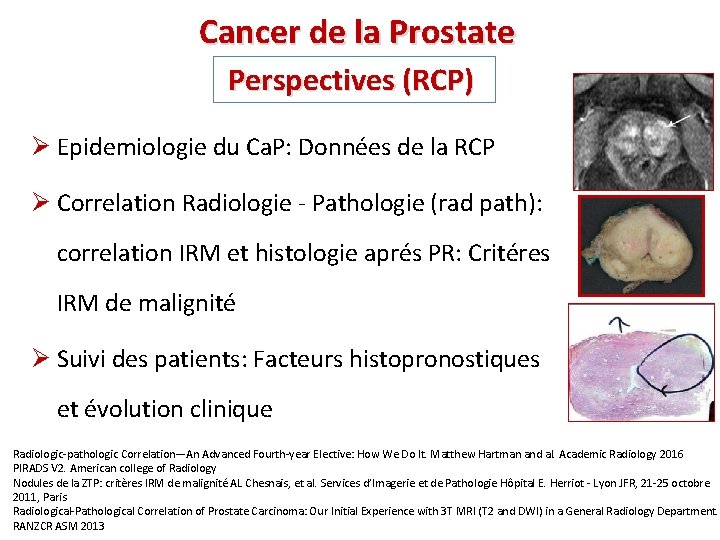 Cancer de la Prostate Perspectives (RCP) Ø Epidemiologie du Ca. P: Données de la