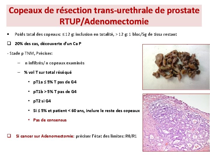 Copeaux de résection trans-urethrale de prostate RTUP/Adenomectomie § Poids total des copeaux: ≤ 12