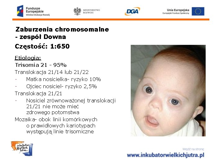 Zaburzenia chromosomalne - zespół Downa Częstość: 1: 650 Etiologia: Trisomia 21 - 95% Translokacja