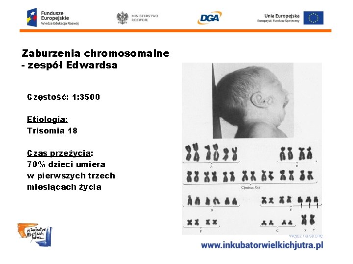 Zaburzenia chromosomalne - zespół Edwardsa Częstość: 1: 3500 Etiologia: Trisomia 18 Czas przeżycia: 70%