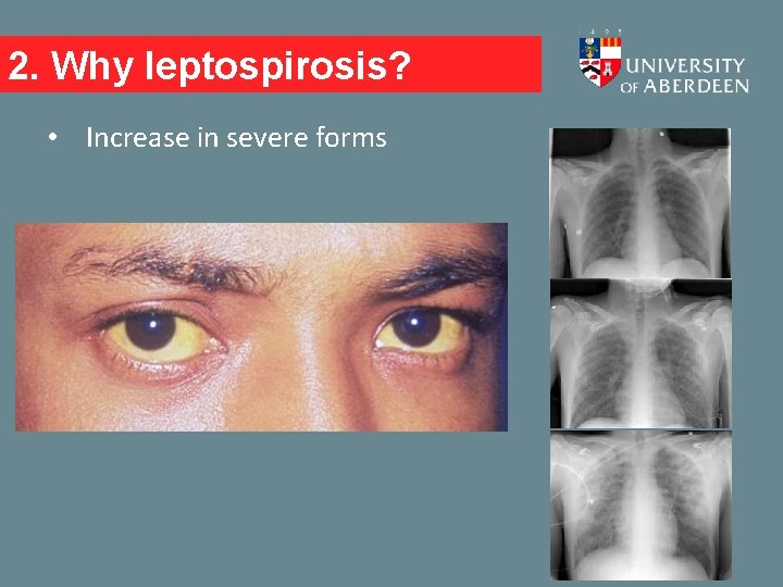 2. Why leptospirosis? • Increase in severe forms 