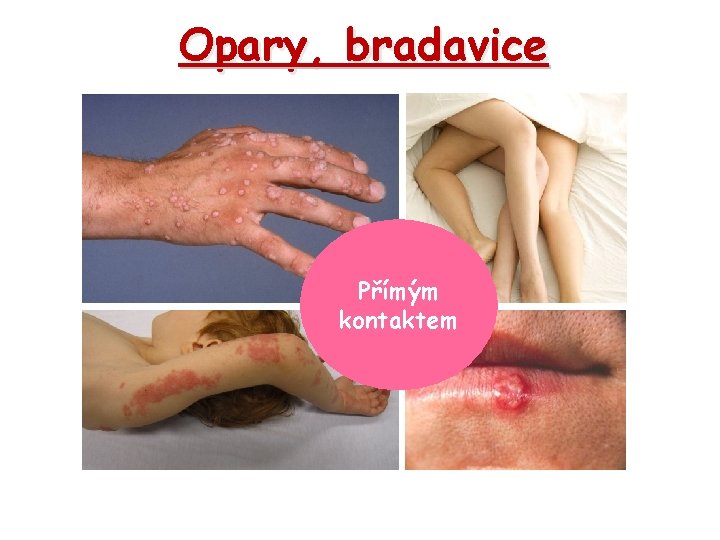 Opary, bradavice Přímým kontaktem 