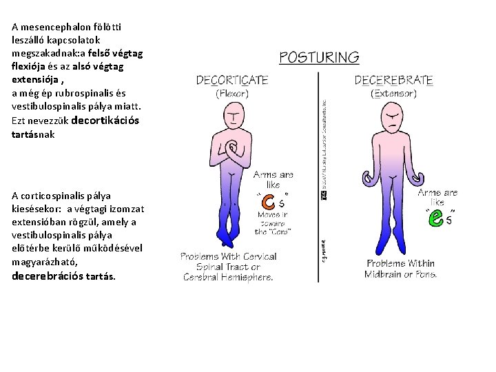 A mesencephalon fölötti leszálló kapcsolatok megszakadnak: a felső végtag flexiója és az alsó végtag