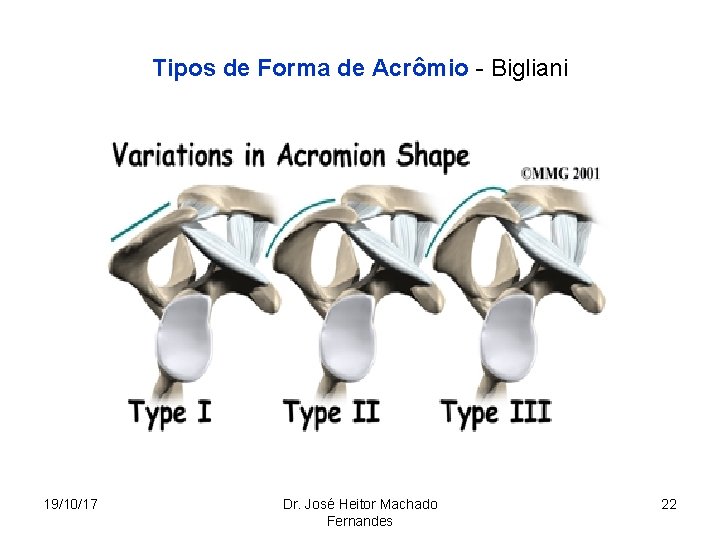 Tipos de Forma de Acrômio - Bigliani 19/10/17 Dr. José Heitor Machado Fernandes 22
