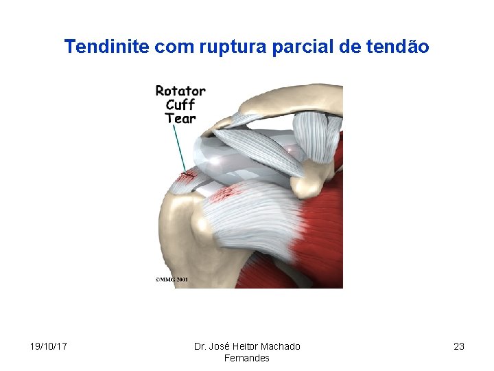 Tendinite com ruptura parcial de tendão 19/10/17 Dr. José Heitor Machado Fernandes 23 