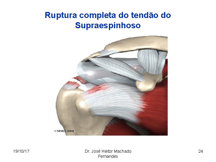 Ruptura completa do tendão do Supraespinhoso 19/10/17 Dr. José Heitor Machado Fernandes 24 