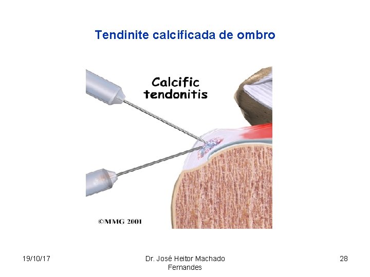 Tendinite calcificada de ombro 19/10/17 Dr. José Heitor Machado Fernandes 28 