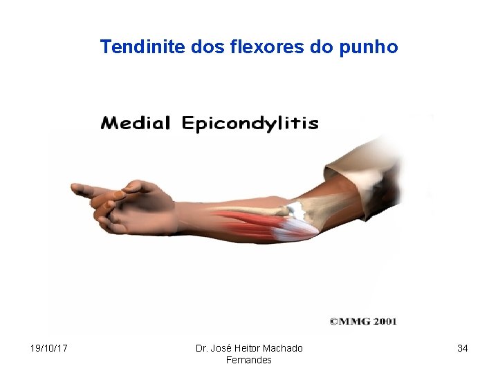 Tendinite dos flexores do punho 19/10/17 Dr. José Heitor Machado Fernandes 34 