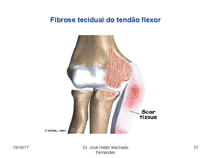 Fibrose tecidual do tendão flexor 19/10/17 Dr. José Heitor Machado Fernandes 37 
