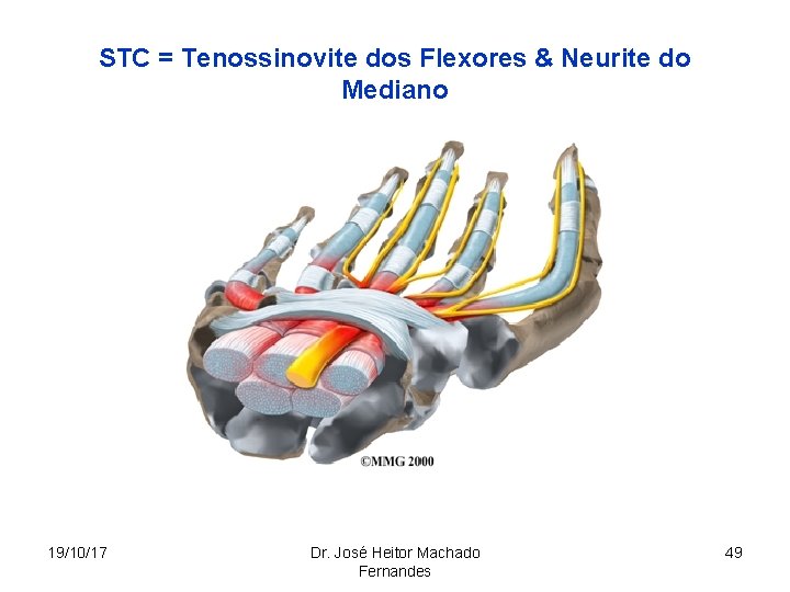 STC = Tenossinovite dos Flexores & Neurite do Mediano 19/10/17 Dr. José Heitor Machado