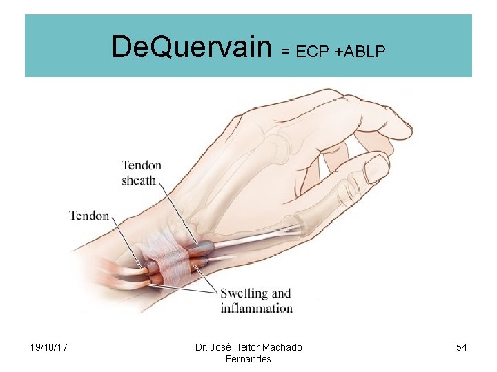 De. Quervain = ECP +ABLP 19/10/17 Dr. José Heitor Machado Fernandes 54 