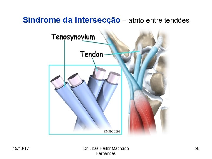 Síndrome da Intersecção – atrito entre tendões 19/10/17 Dr. José Heitor Machado Fernandes 58