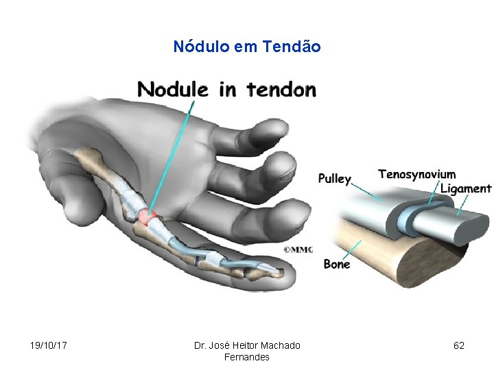 Nódulo em Tendão 19/10/17 Dr. José Heitor Machado Fernandes 62 