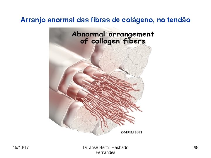 Arranjo anormal das fibras de colágeno, no tendão 19/10/17 Dr. José Heitor Machado Fernandes