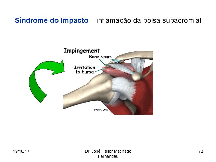 Síndrome do Impacto – inflamação da bolsa subacromial 19/10/17 Dr. José Heitor Machado Fernandes