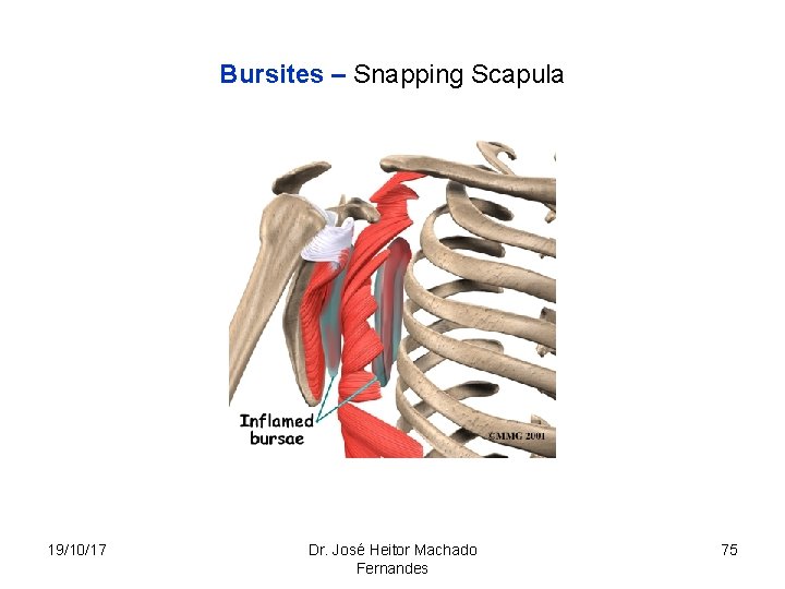 Bursites – Snapping Scapula 19/10/17 Dr. José Heitor Machado Fernandes 75 