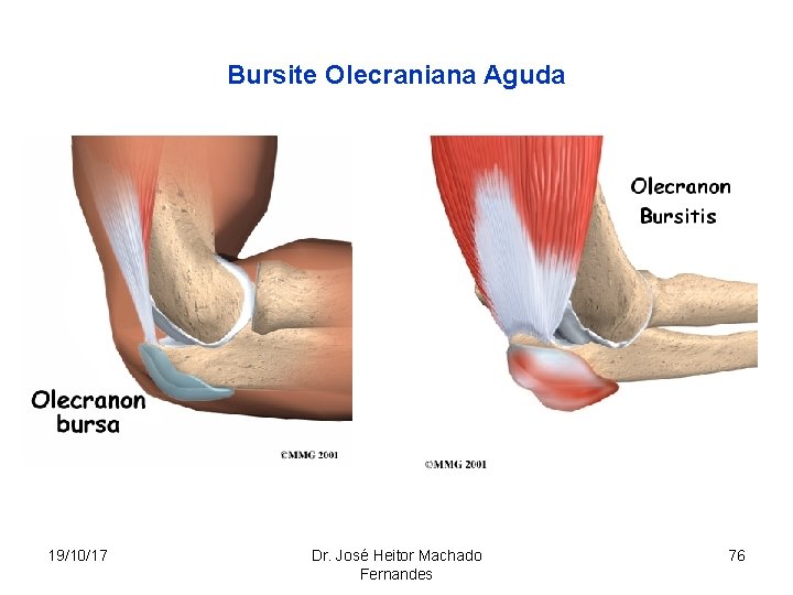 Bursite Olecraniana Aguda 19/10/17 Dr. José Heitor Machado Fernandes 76 