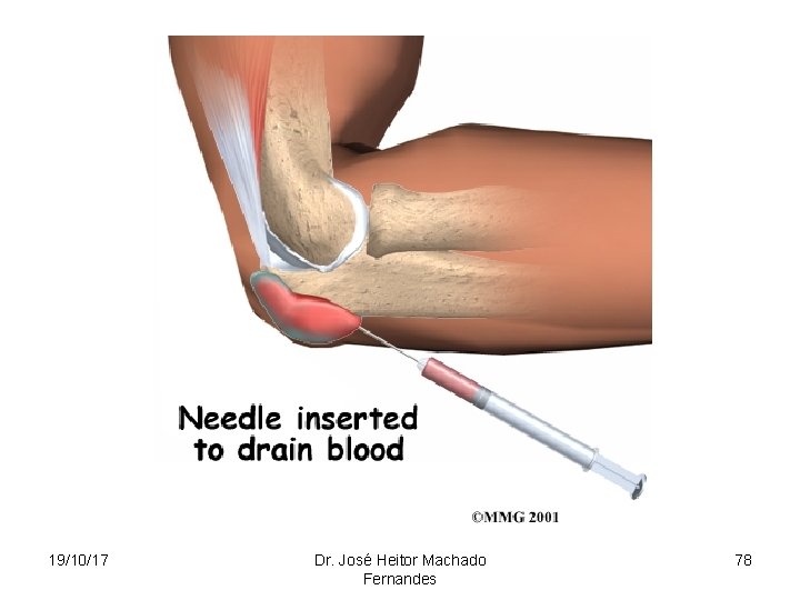 19/10/17 Dr. José Heitor Machado Fernandes 78 