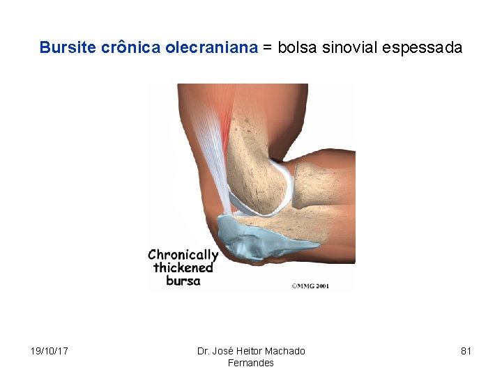 Bursite crônica olecraniana = bolsa sinovial espessada 19/10/17 Dr. José Heitor Machado Fernandes 81