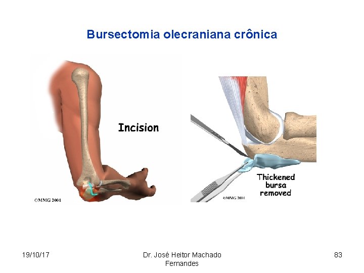 Bursectomia olecraniana crônica 19/10/17 Dr. José Heitor Machado Fernandes 83 