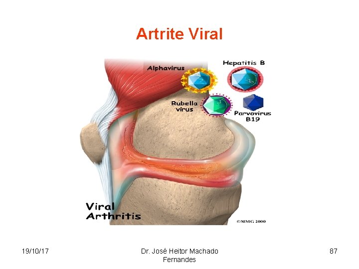 Artrite Viral 19/10/17 Dr. José Heitor Machado Fernandes 87 