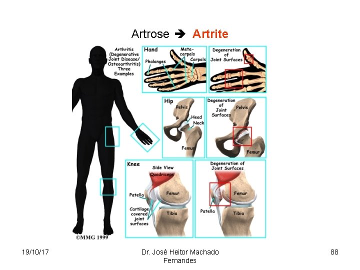 Artrose Artrite 19/10/17 Dr. José Heitor Machado Fernandes 88 
