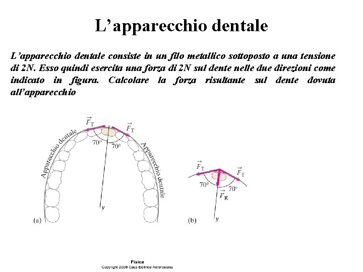 L’apparecchio dentale consiste in un filo metallico sottoposto a una tensione di 2 N.