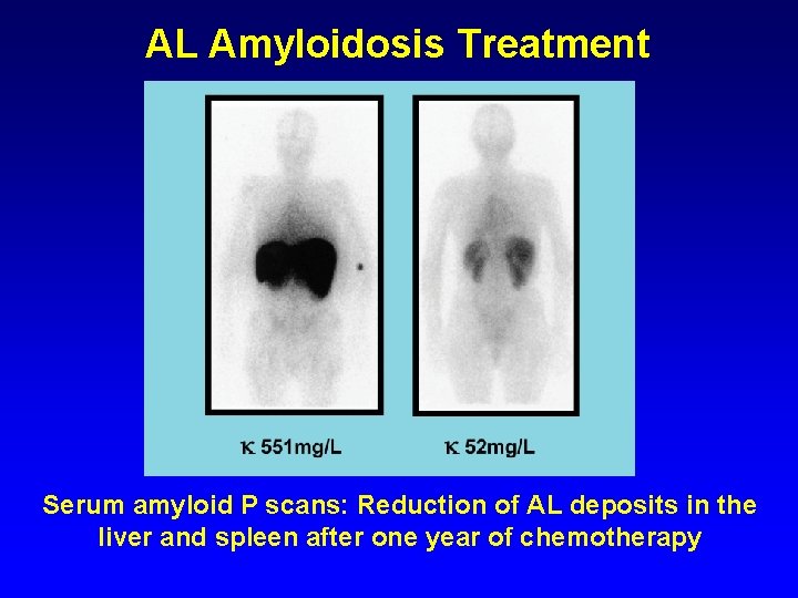 AL Amyloidosis Treatment Serum amyloid P scans: Reduction of AL deposits in the liver