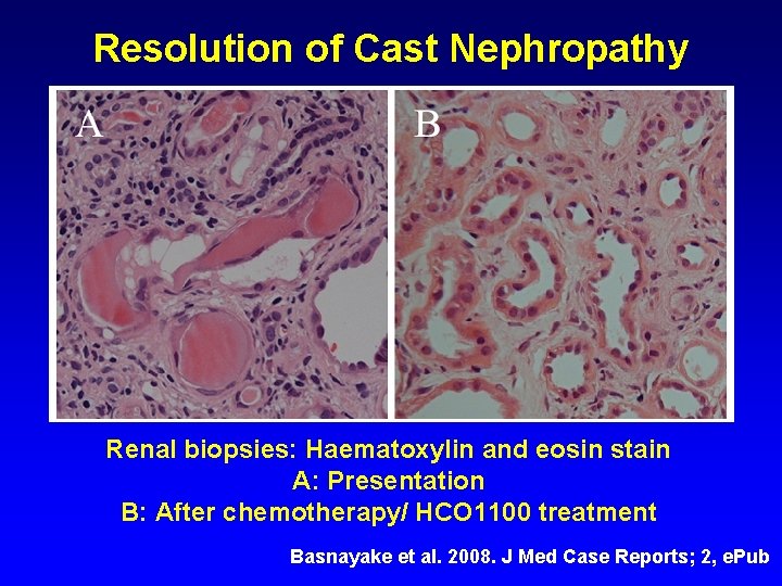 Resolution of Cast Nephropathy Renal biopsies: Haematoxylin and eosin stain A: Presentation B: After