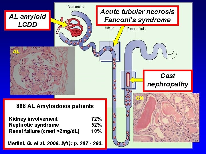 Acute tubular necrosis Fanconi’s syndrome AL amyloid LCDD AL Cast nephropathy CN 868 AL