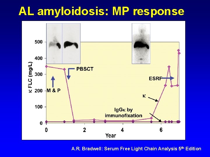 AL amyloidosis: MP response A. R. Bradwell: Serum Free Light Chain Analysis 5 th