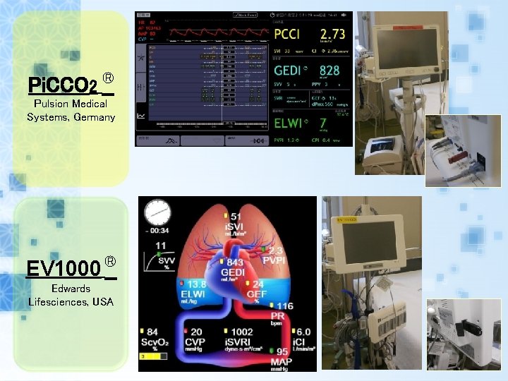 Pi. CCO 2 ® Pulsion Medical Systems, Germany EV 1000 ® Edwards Lifesciences, USA