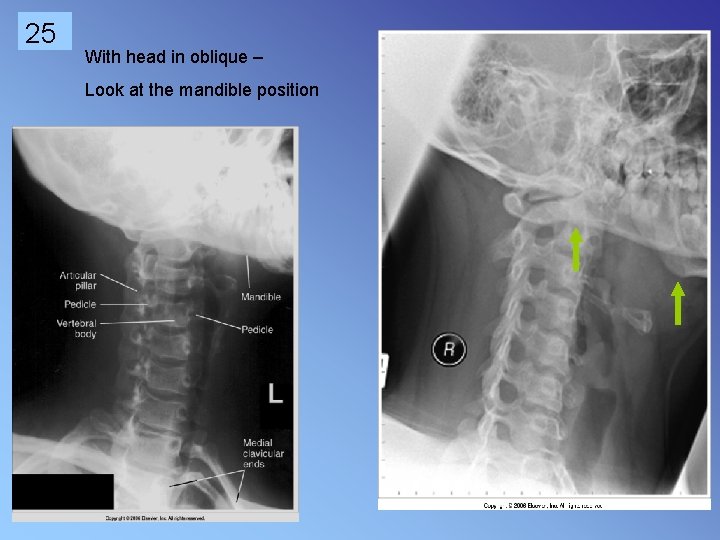 25 With head in oblique – Look at the mandible position 