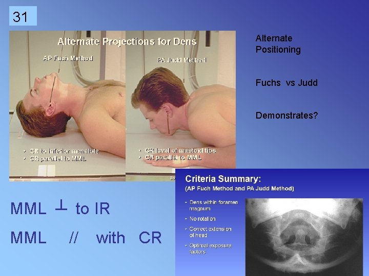 31 Alternate Positioning Fuchs vs Judd Demonstrates? MML ┴ to IR MML // with