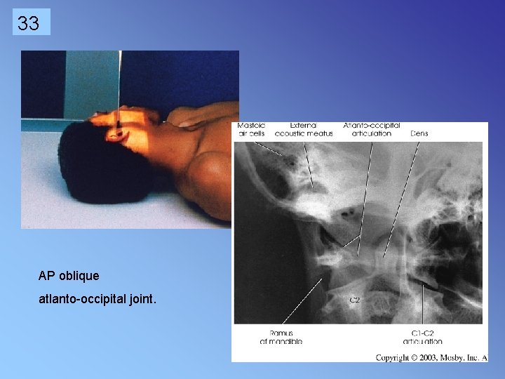 33 AP oblique atlanto-occipital joint. 