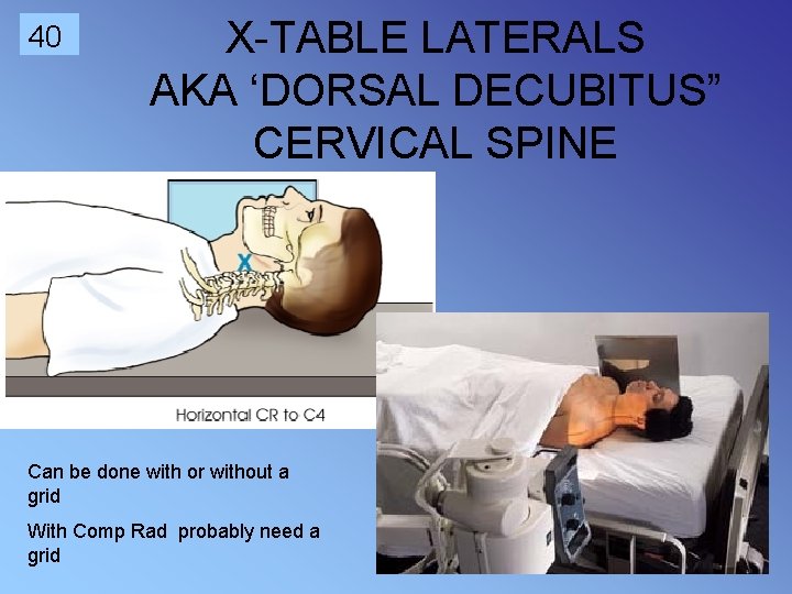 40 X-TABLE LATERALS AKA ‘DORSAL DECUBITUS” CERVICAL SPINE Can be done with or without