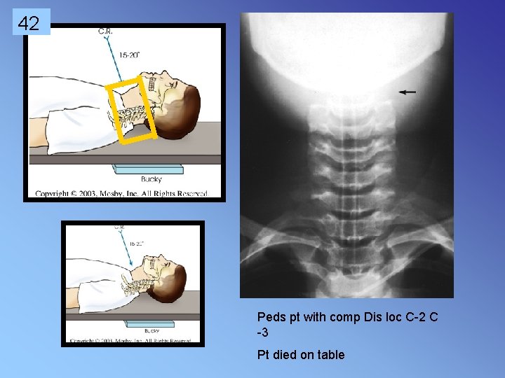 42 Peds pt with comp Dis loc C-2 C -3 Pt died on table