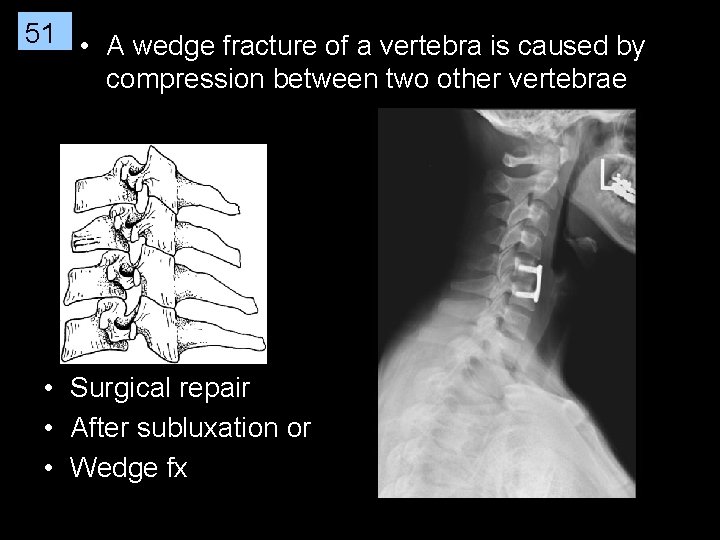 51 • A wedge fracture of a vertebra is caused by compression between two