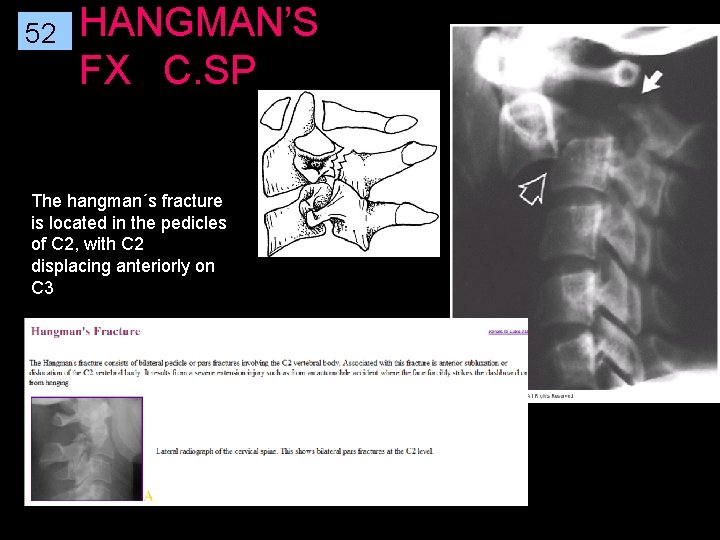 52 HANGMAN’S FX C. SP The hangman´s fracture is located in the pedicles of