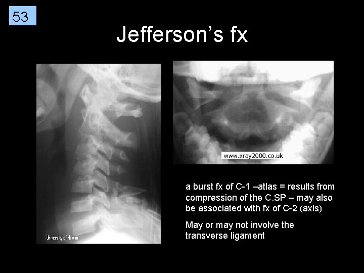 53 Jefferson’s fx a burst fx of C-1 –atlas = results from compression of