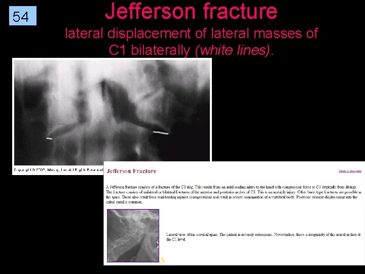 54 Jefferson fracture lateral displacement of lateral masses of C 1 bilaterally (white lines).