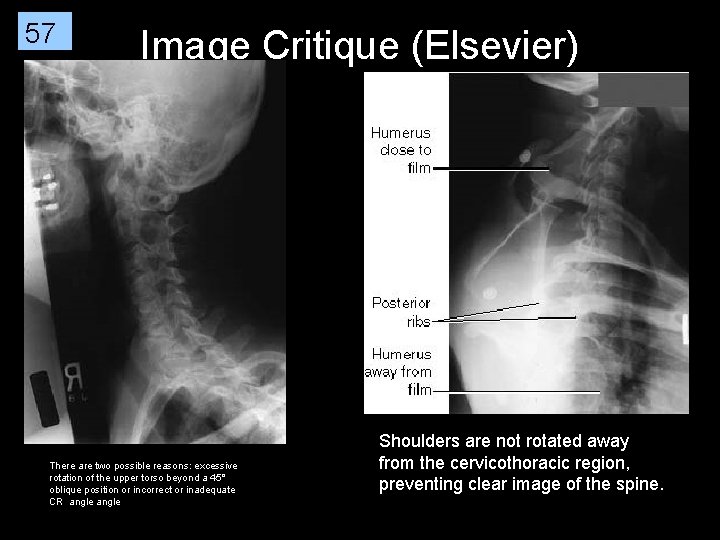 57 Image Critique (Elsevier) There are two possible reasons: excessive rotation of the upper