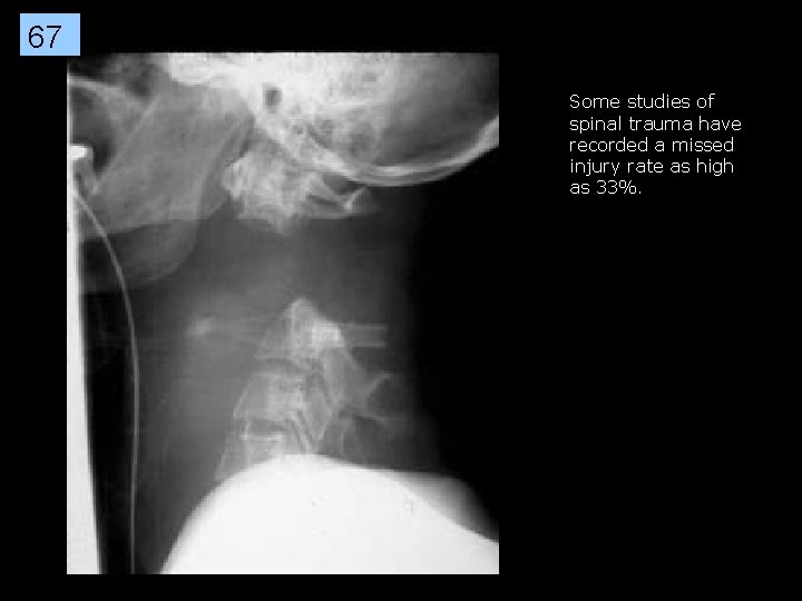 67 Some studies of spinal trauma have recorded a missed injury rate as high