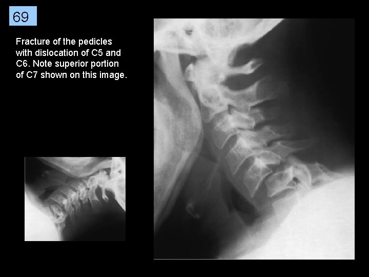 69 Fracture of the pedicles with dislocation of C 5 and C 6. Note