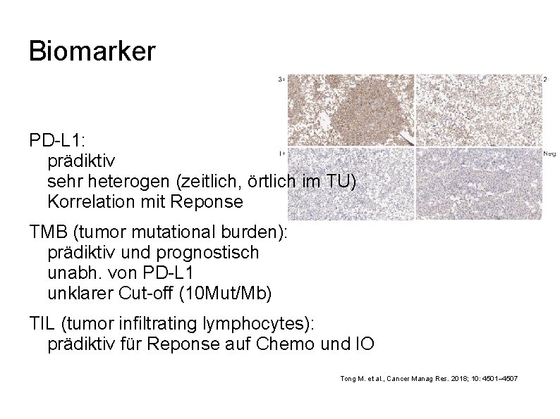 Biomarker PD-L 1: prädiktiv sehr heterogen (zeitlich, örtlich im TU) Korrelation mit Reponse TMB
