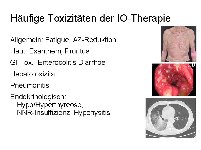 Häufige Toxizitäten der IO-Therapie Allgemein: Fatigue, AZ-Reduktion Haut: Exanthem, Pruritus GI-Tox. : Enterocolitis Diarrhoe