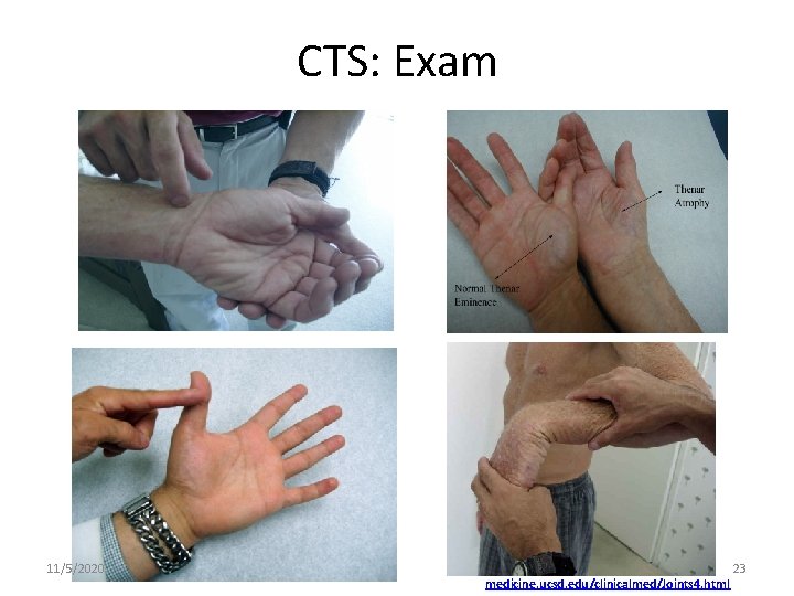 CTS: Exam 11/5/2020 medicine. ucsd. edu/clinicalmed/Joints 4. html 23 